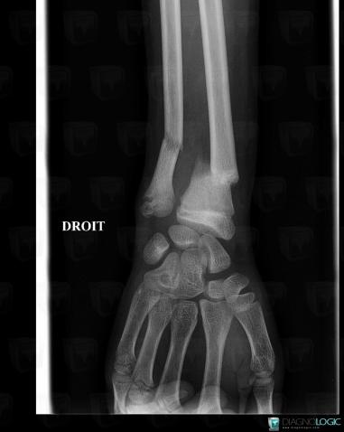 Fracture, Radius - Distal part, Ulna - Distal part, X rays