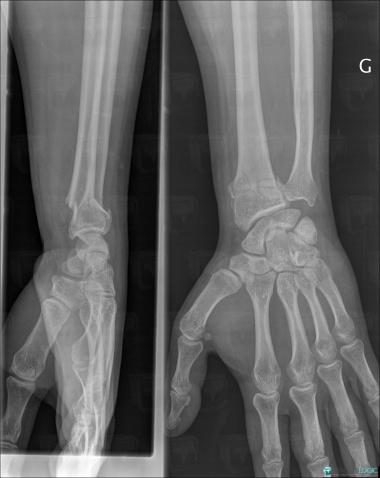 Fracture, Radius - Distal part, X rays