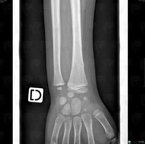 Fracture, Radius - Distal part, X rays Fracture, Radius - Distal part, X rays