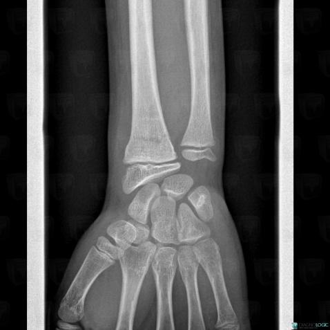 Fracture, Radius - Distal part, X rays
