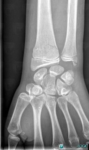 Fracture, Radius - Distal part, X rays