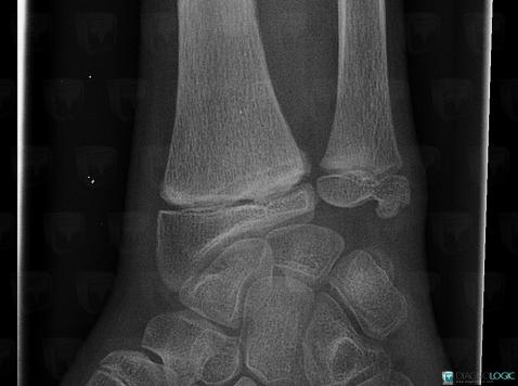 Fracture, Radius - Distal part, X rays