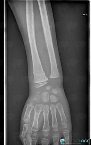 Fracture, Radius - Distal part, X rays