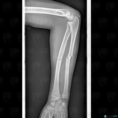 Fracture, Radius - Mid part, Ulna - Mid part, X rays