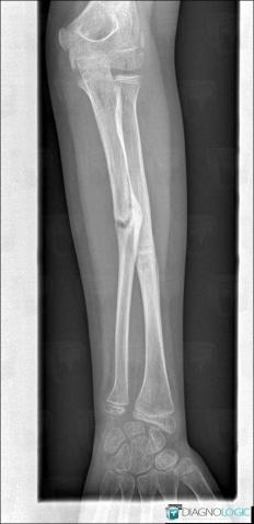 Fracture, Radius - Mid part, Ulna - Mid part, X rays