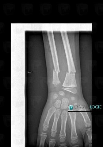 Fracture, Radius -moyen, Ulna -inférieur, Radio
