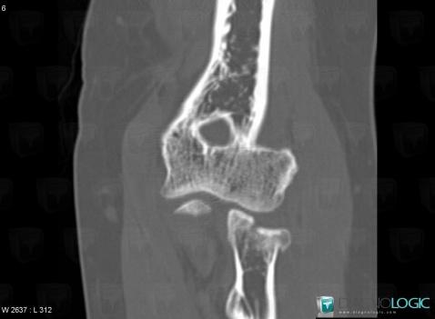 Fracture, Radius - Proximal part, CT