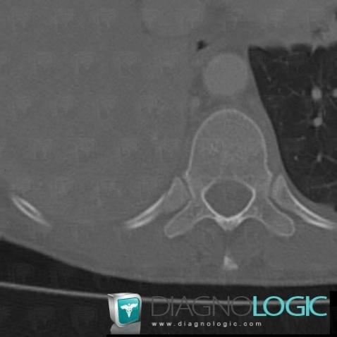 Fracture, Ribs, CT