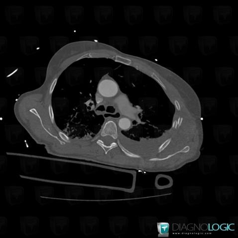 Fracture, Ribs, CT