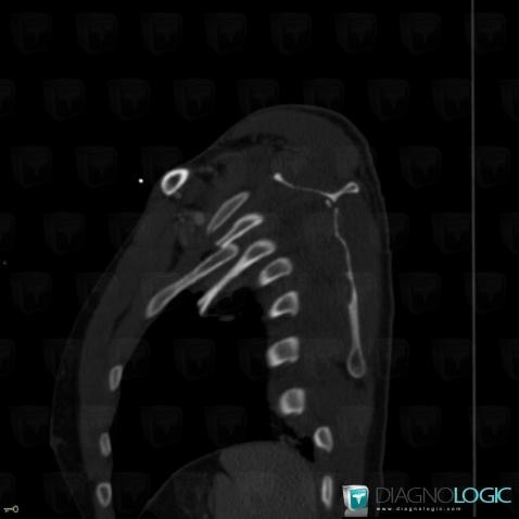 Fracture, Ribs, CT