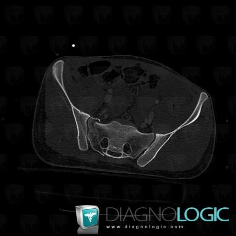 Fracture, Sacrum / Coccyx, CT