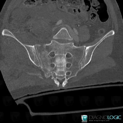 Fracture, Sacrum / Coccyx, CT