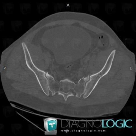 Fracture, Sacrum / Coccyx, CT