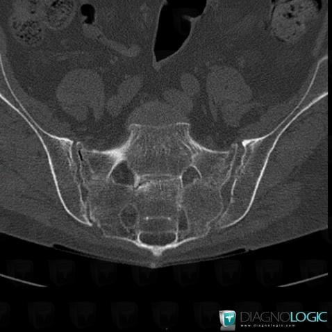 Fracture, Sacrum / Coccyx, Scanner