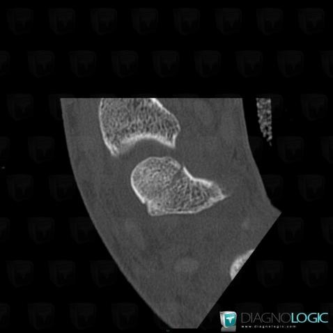 Fracture, Scaphoid, CT