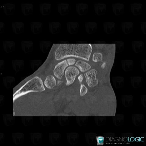 Fracture, Scaphoid, CT