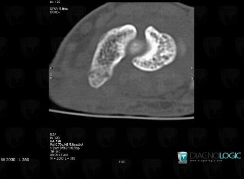 Fracture, Scaphoid, CT