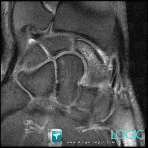 Fracture, Scaphoid, MRI