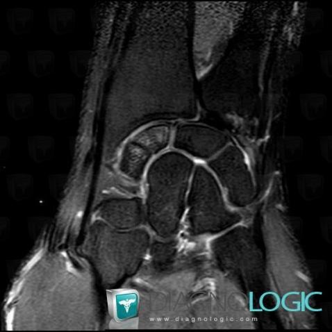 Fracture, Scaphoid, MRI