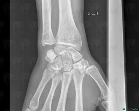 Fracture, Scaphoid, X rays