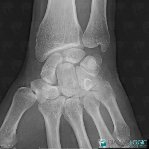 Fracture, Scaphoid, X rays