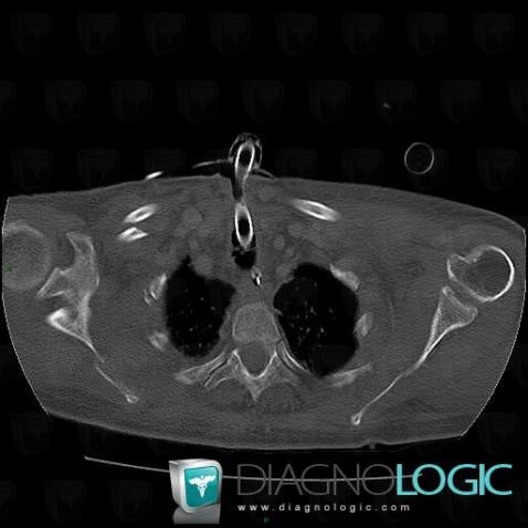 Fracture, Scapula, Clavicle, CT