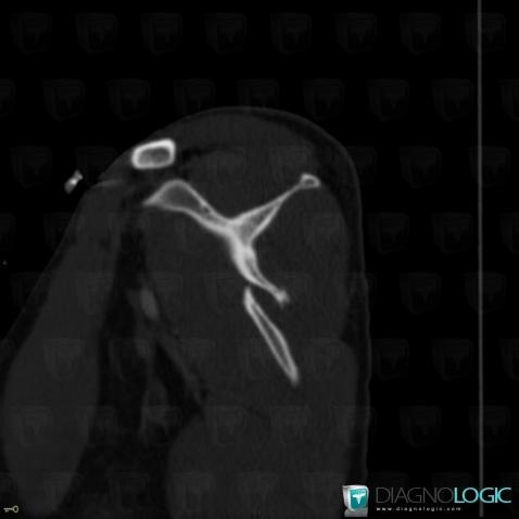 Fracture, Scapula, CT