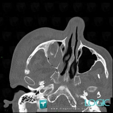 Radiology case : Hemosinus (CT) - Diagnologic