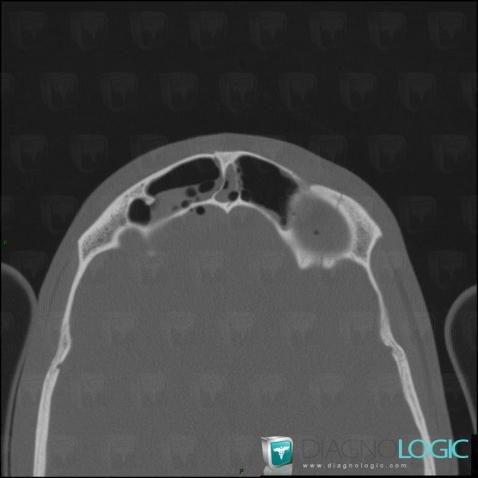 Fracture, Sinus, Scanner
