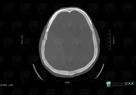 Fracture, Skull vault, CT