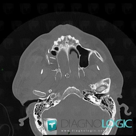 Fracture, Sphenoïde, Scanner