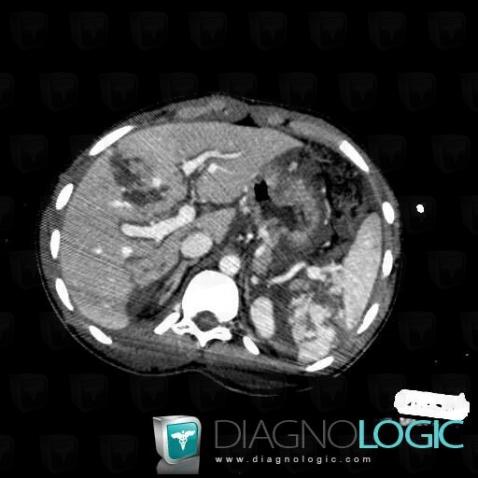 Fracture, Spleen, CT