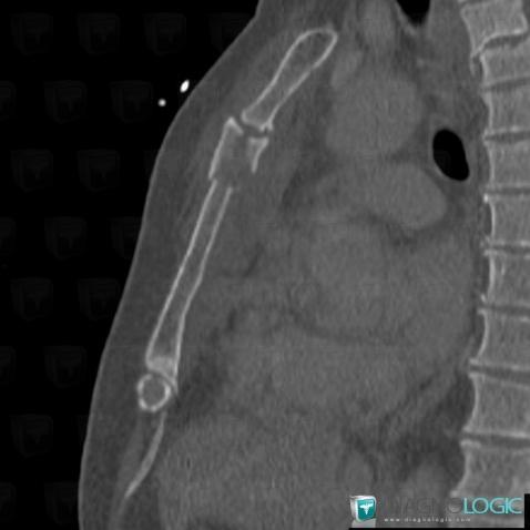 Fracture, Sternum, CT