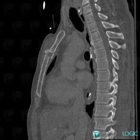 Fracture, Sternum, CT