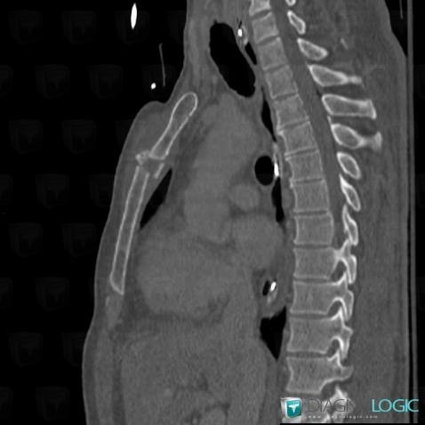 Fracture, Sternum, Scanner