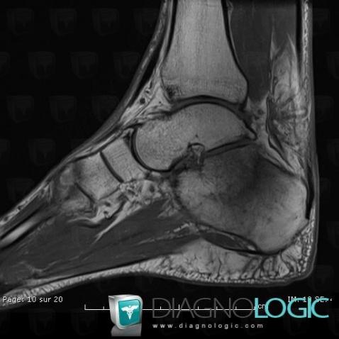 Fracture-stress, Calcanéus, IRM