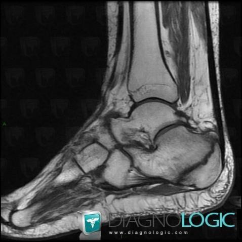 Fracture-stress, Calcanéus, IRM