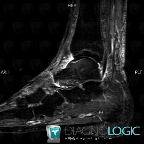 Fracture-stress, Talus, IRM