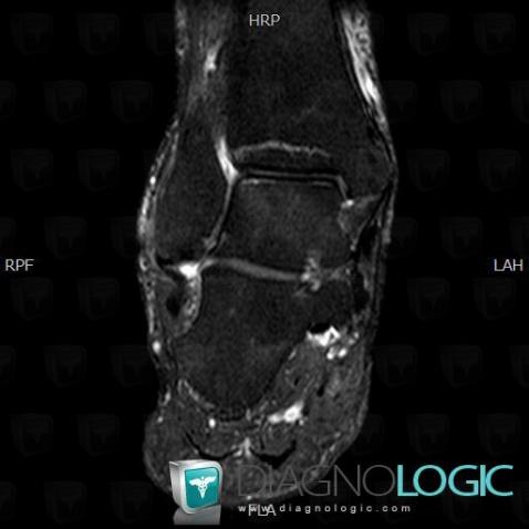 Fracture-stress, Tibia -inférieur, IRM