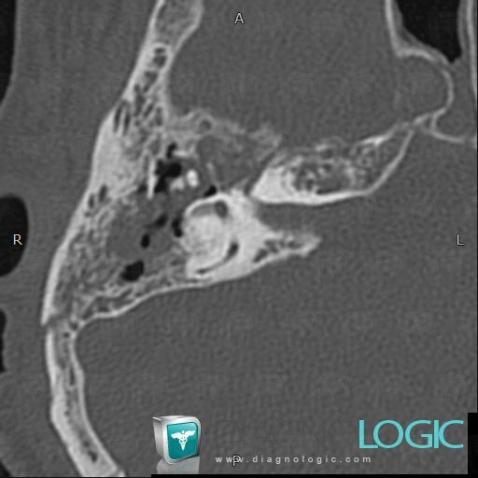 Fracture, Temporal bone, CT