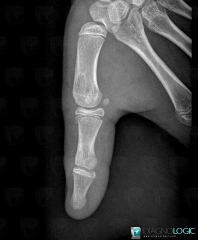 Fracture, Thumb, X rays