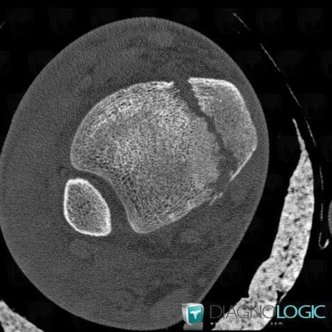 Fracture, Tibia - Distal part, CT