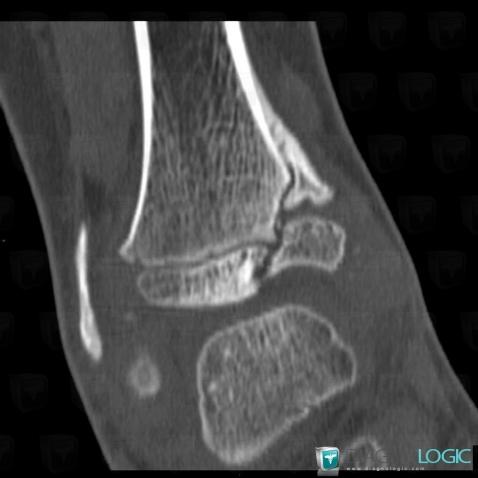 Fracture, Tibia - Distal part, CT