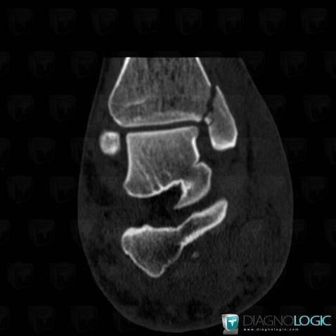 Fracture, Tibia - Distal part, CT