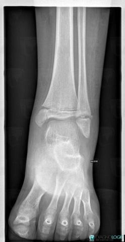 Fracture, Tibia - Distal part, Fibula - Distal part, X rays