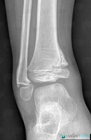 Fracture, Tibia - Distal part, X rays