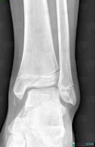 Fracture, Tibia - Distal part, X rays