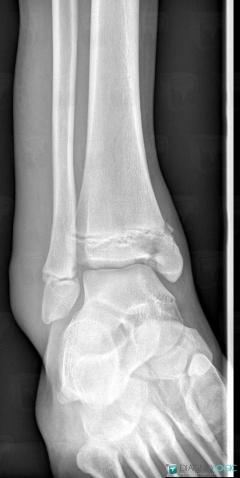 Fracture, Tibia -inférieur, Fibula -inférieur, Radio