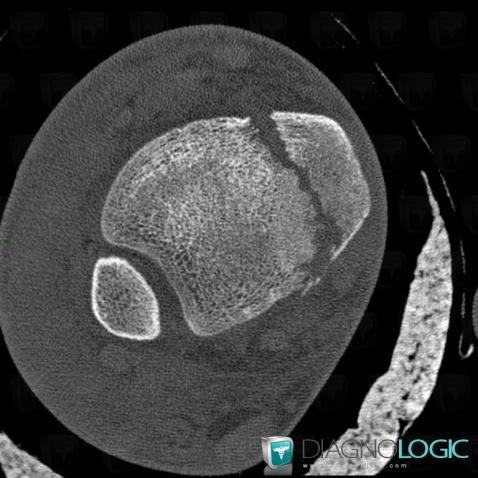 Fracture, Tibia -inférieur, Scanner