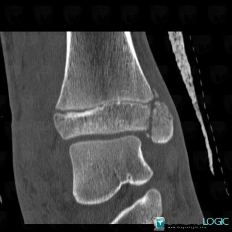Fracture, Tibia -inférieur, Scanner
